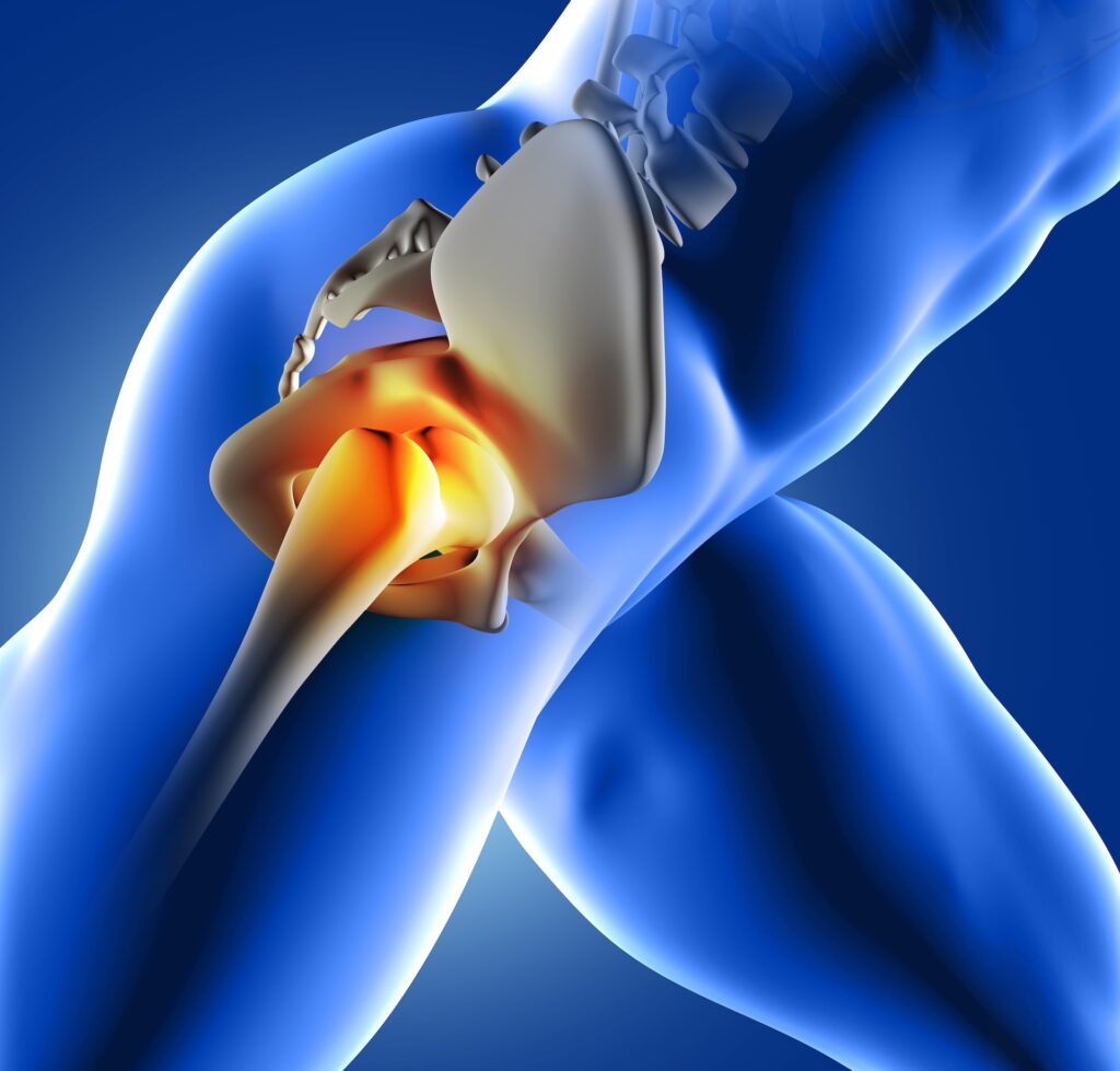 Hip Replacement and the Recovery of Mobility in Patients